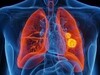 Testul degetelor care poate depista semnele timpurii ale cancerului pulmonar