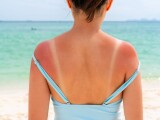 Arsurile solare - remedii la îndemâna oricui se arde la soare. Metode de tratament și prevenție