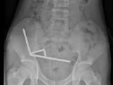 Un băiat de 13 ani a fost operat de urgență după ce a înghițit peste 100 de magneți. Ce le-a dezvăluit medicilor. FOTO