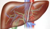 Steatoza hepatică non-alcoolică poate fi ţinută sub control cu exerciţii fizice zilnice şi o alimentaţie bogată în&nbsp;(…)