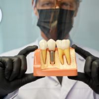 Implant dentar 2025 – etape, tipuri și costuri (P)