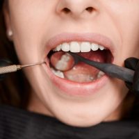 Ce se întâmplă dacă nu înlocuiești un dinte lipsă: efecte pe termen lung (P)