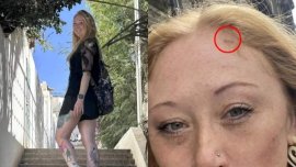 A aflat că are cancer de piele după ce a mers la solar. O artistă a trecut prin 13 intervenții chirurgicale după&nbsp;(…)