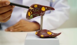 Boala ficatului gras, o problemă globală. Care este 