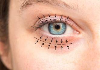 (P) Cât durează recuperarea după o procedură de blefaroplastie superioară?