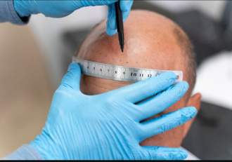 Un bărbat a decedat, în urma unui implant de păr, realizat în Turcia. Acesta fusese supus și unei intervenții (…)