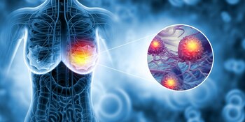 Medic senolog, despre cât de mult contează prevenția și genetica în cancerul la sân. „Mamografia: două minute care (…)