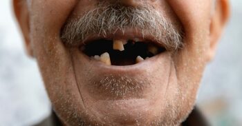 Pierderea rapidă a dinților la vârste înaintate poate semnala un risc crescut de deces, arată un studiu