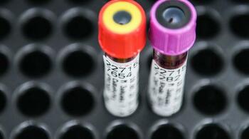 SUA aprobă un nou test de sânge care ajută la detectarea bolii Alzheimer