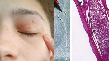 Cazul care a șocat medicina din România! Vierme de 11 centimetri, descoperit în pleoapa unei femei