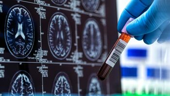 Diagnosticarea bolii Alzheimer cu analize de sânge