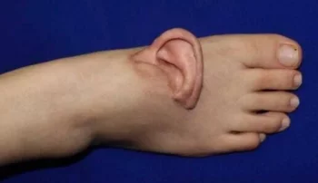 Femeia care trăiește cu o ureche pe picior: cazul dramatic din spatele acestei imagini