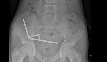 Un băiat de 13 ani din Noua Zeelandă a rămas fără o parte din intestin după ce a înghiţit zeci de magneţi