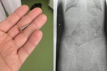 Un dentist din Iași a scăpat în gura unui copil de 5 ani o freză metalică, apoi le-a spus părinților că a înghițit o (…)