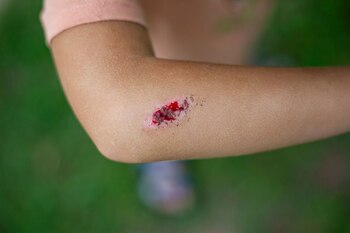 Boala infecțioasă gravă, cu mortalitate ridicată dacă nu este tratată rapid și corect. Sporii care o cauzează pot (…)