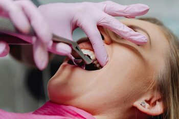 3 situații în care o persoană poate avea nevoie de chirurgie dentară (P)