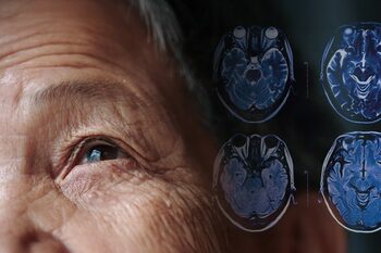 Noi descoperiri legate de tratamentul bolii Parkinson: Ce au aflat oamenii de știință, cât de simplă ar fi soluția, (…)