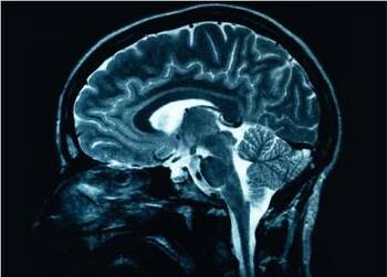 Creierul bărbaţilor se micşorează mai rapid decât al femeilor, arată un nou studiu despre Alzheimer