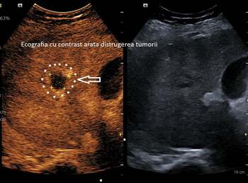 Spitalul Județean Craiova anunţă realizarea primei ablaţii cu microunde a unei tumori hepatice / La o lună după (…)