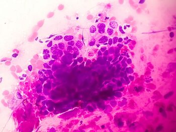 Un nou vaccin împotriva cancerului a blocat tumorile la șoareci