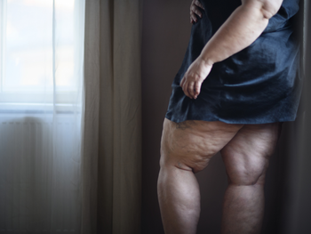 Cum afectează obezitatea libidoul și sexualitatea